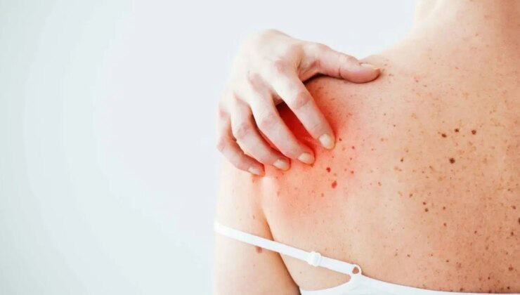 Uzun süre güneş altında kalanlar dikkat! Cilt tümörlerine neden oluyor…