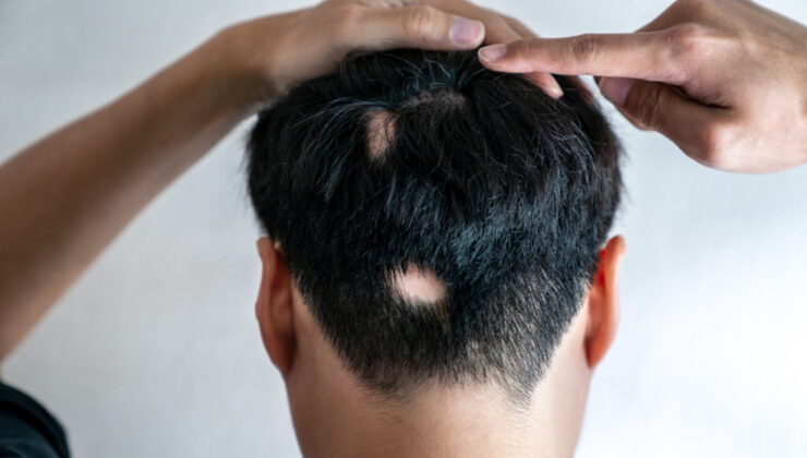 Yoğun stres erkeklerde saçkırana neden oluyor