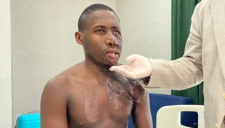 Yüzü yanan Ugandalı çoban, Ankara’da sağlığına kavuştu