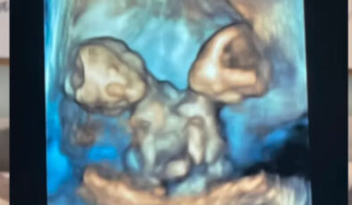 ABD’de bir anne zor olanı seçti: Yapışık ikizler doğar doğmaz hayata veda ettiler