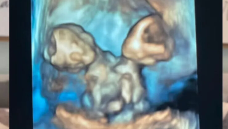 ABD’de bir anne zor olanı seçti: Yapışık ikizler doğar doğmaz hayata veda ettiler