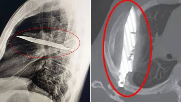 Ağrı şikayetiyle hastaneye başvurdu: Röntgende ortaya çıktı