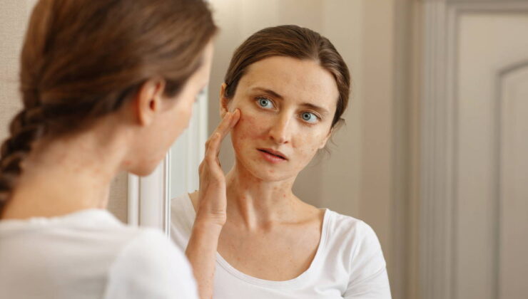 Cildinizdeki ton ve renk eşitsizliğinin sebebi bu rahatsızlık olabilir: Yaz mantarı ve sık karşılaşılan 5 belirtisi