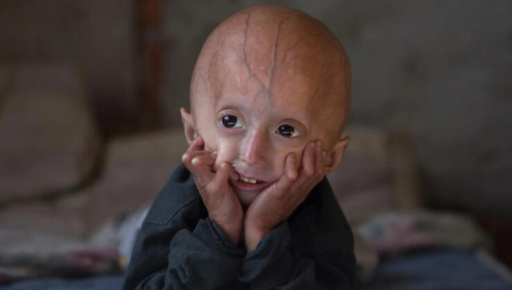 Çocuklarda hızla yaşlanmaya, ömür kısalmasına neden oluyor: Progeria hastalığı