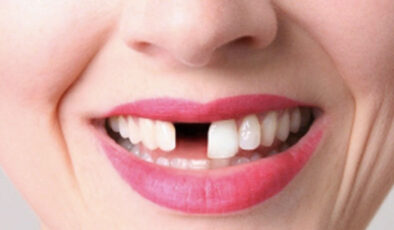 Diş eksikliği, yüz estetiğinde bozulmaya neden oluyor