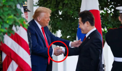 Donald Trump’ın eli neden morardı? İşte sebebi
