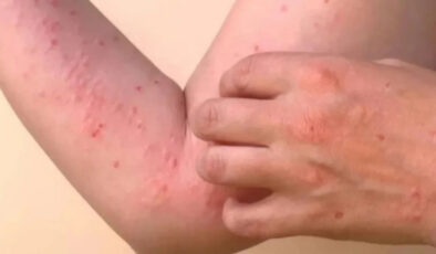 DSÖ’nün uyardığı Chikungunya virüsü tehlikeli değil