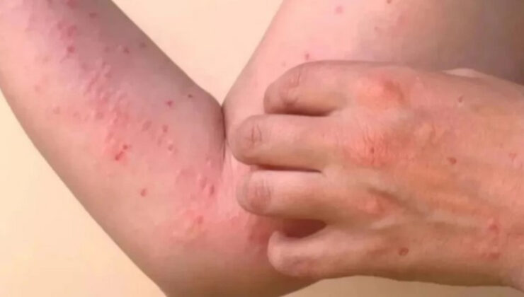 DSÖ’nün uyardığı Chikungunya virüsü tehlikeli değil