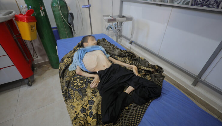 Gazze’de felaket devam ediyor: Felçli genç yetersiz beslenmeden yaşamını yitirdi