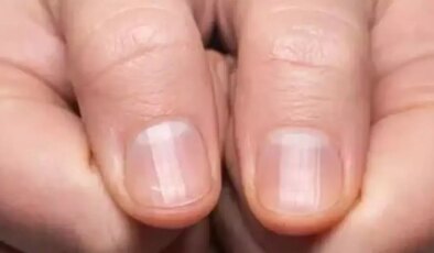 Gizli hastalık tırnaklarda görülüyor: Tedavi edilmezse kalp yetmezliğine götürebilir