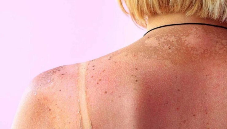 Güneş lekelerine veda: Cilt tonunu eşitleyen etkili yöntem