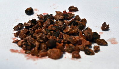 Hepsi böbreğinden çıkarıldı: Yaklaşık 100 adet…