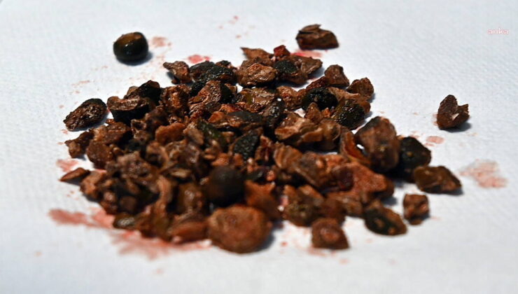 Hepsi böbreğinden çıkarıldı: Yaklaşık 100 adet…