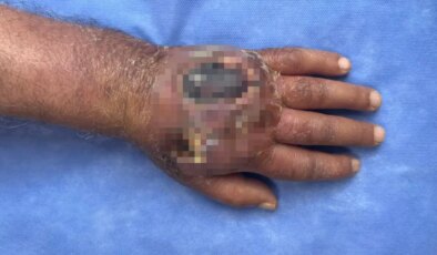 Hırsızın ısırığı kolundan ediyordu: Vaka literatüre girmeye aday