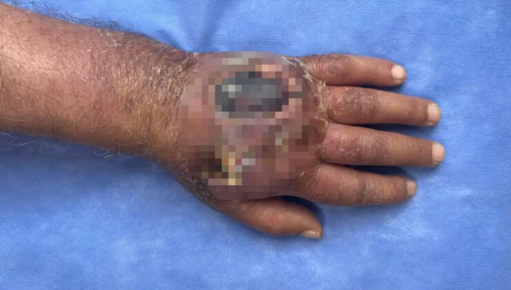 Hırsızın ısırığı kolundan ediyordu: Vaka literatüre girmeye aday