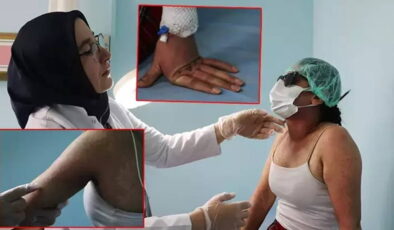 İnternetten sipariş verdiği krem hastanelik etti