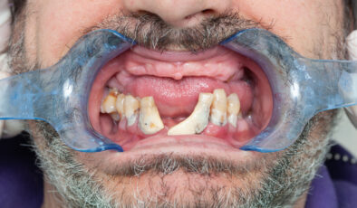 Kalp rahatsızlıklarının ardındaki sıradışı suçlu: Diş fırçalamamak