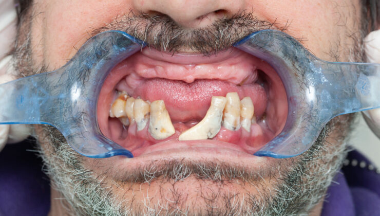 Kalp rahatsızlıklarının ardındaki sıradışı suçlu: Diş fırçalamamak