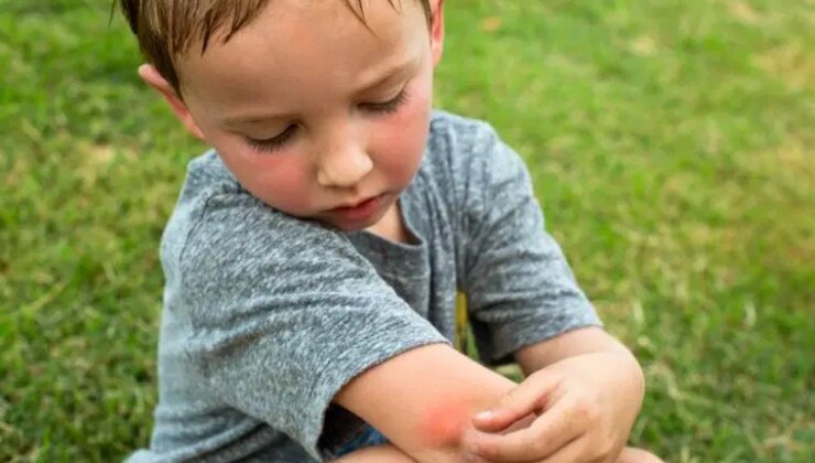 Kaşıntıyı durduruyor, yara ve kızarıklıktan eser bırakmıyor: Sivrisinek ısırıklarına iyi gelen 7 doğal yöntem