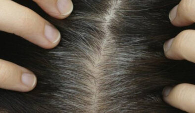 Saçlarınız erken beyazlıyorsa dikkat! Bu uyarılara kulak verin!