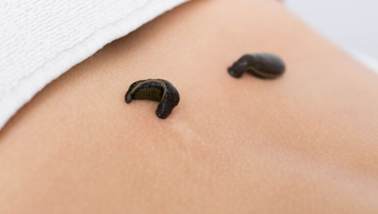 Sülük ne işe yarar? Sülük tedavisi işe yarıyor mu?