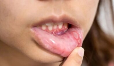 Uzmanlardan uyarı: Ağız yaraları görünenden zararlı olabilir