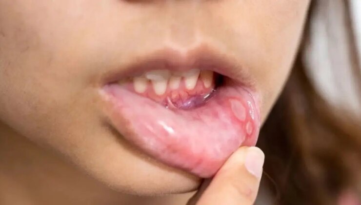 Uzmanlardan uyarı: Ağız yaraları görünenden zararlı olabilir