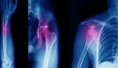 Ameliyatlarda yeni dönem: Kırık kemikler 3D baskıyla anında tamir ediliyor