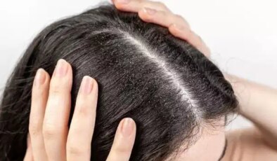 Doğal yollarla saç derinizi arındırın: Kepek problemine son veren süper etkili 7 doğal çözüm