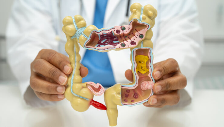 Genç ve orta yaş grubunda sıkça rastlanan gizli tehdit: Apandisit kanseri