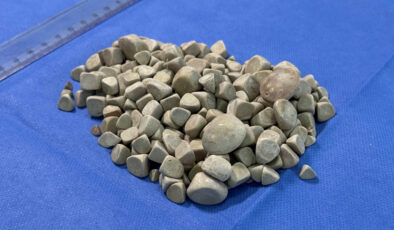 İstanbul’da karın ağrısıyla doktora gitti: Vücudunda 287 tane taş çıktı