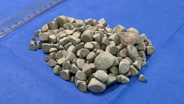 İstanbul’da karın ağrısıyla doktora gitti: Vücudunda 287 tane taş çıktı