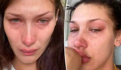 Lyme Hastalığı nedir? Lyme hastalığı belirtileri neler? Lyme hastalığı nasıl tedavi edilir?