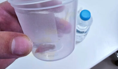 Malatya’da 1,5 yıllık öksürüğün nedeni kabak çekirdeği çıktı