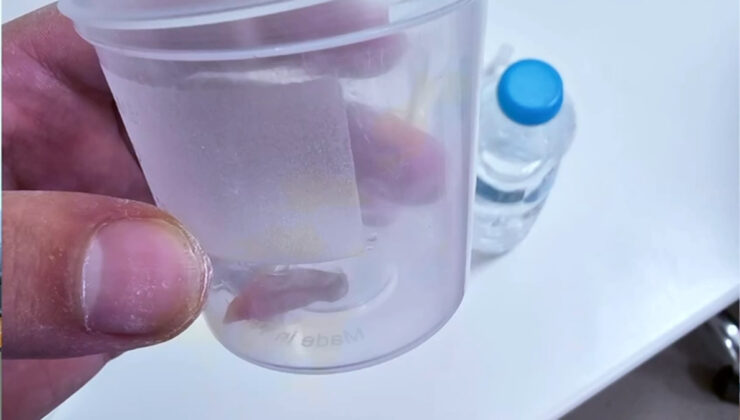 Malatya’da 1,5 yıllık öksürüğün nedeni kabak çekirdeği çıktı