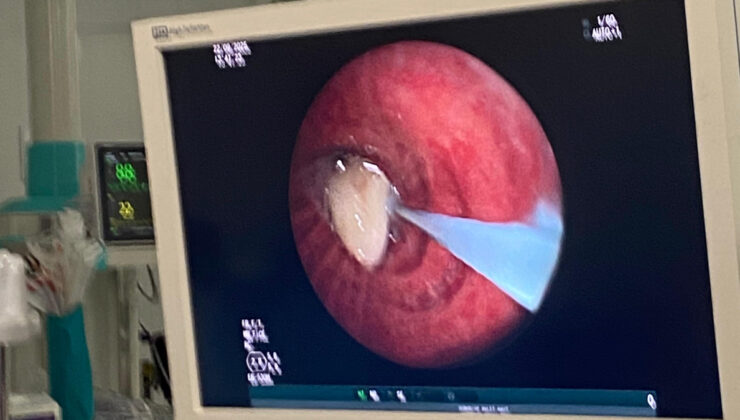 Osmaniye’de hastanın akciğerine kaçan sarımsak, operasyonla çıkarıldı