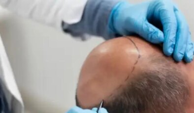 Saç ekimi birimleri hakkında yönetmelik değişikliği Resmi Gazete’de