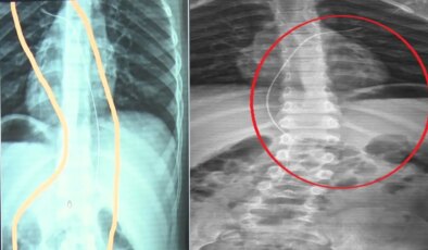 Salatalık yuttu, gerçek hastanede ortaya çıktı: 6 yaşındaki çocuğun içinde kateter unutmuşlar!