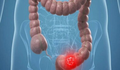 Uzmanından uyarı: Bağırsak kanseri gençlerde de artıyor