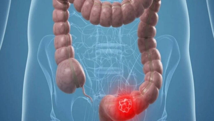 Uzmanından uyarı: Bağırsak kanseri gençlerde de artıyor