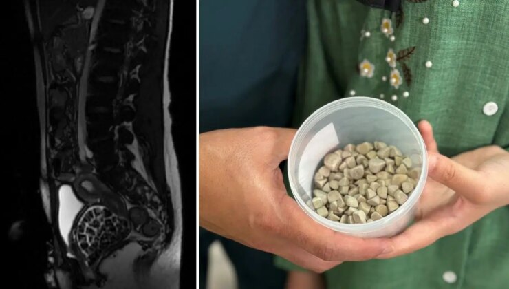 Vücudundan 287 tane taş çıkarıldı, doktorlar bile şok oldu: “Literatürde çok nadir görülen bir olay”