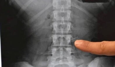 16 yaşındaki çocuğun yuttuğu toplu iğne akciğerine saplandı!