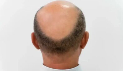 3 haftada saç çıkaran ‘mucize serum’ geliştirildi