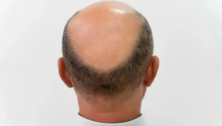 3 haftada saç çıkaran ‘mucize serum’ geliştirildi