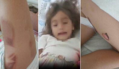 3 yaşındaki Yaren apandisit ameliyatından yanık izleriyle çıktı!