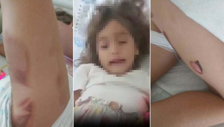 3 yaşındaki Yaren apandisit ameliyatından yanık izleriyle çıktı!