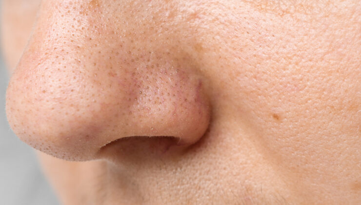 Burun tıkanıklığı kabus olmasın: 4 pratik yöntemle kurtulun