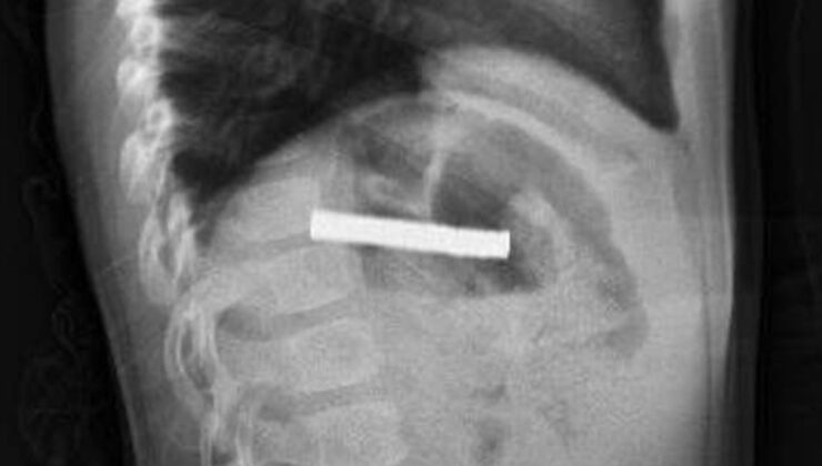 Elazığ’da çocuğun boğazından 19 adet mıknatıs çıkartıldı