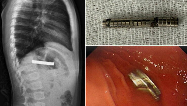 Elazığ’da doktorları şaşırtan olay: Çocuğun yemek borusundan 19 mıknatıs çıkarıldı!