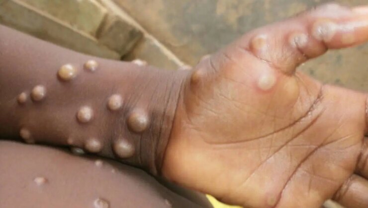 Gana’da ‘maymun çiçeği’ alarmı… Vaka sayısı 583’e yükseldi!